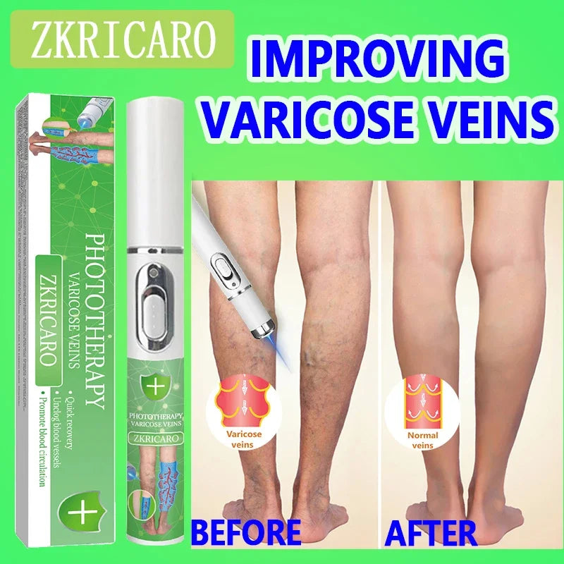High tech Laser therapy improves moderate varicose veins relieves pain and Improves circulation for men women - Supersell