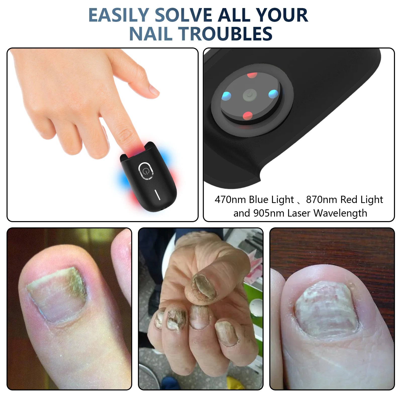 KTS Nail Fungus Laser Device Toenail Laser Therapy Machine - Supersell 