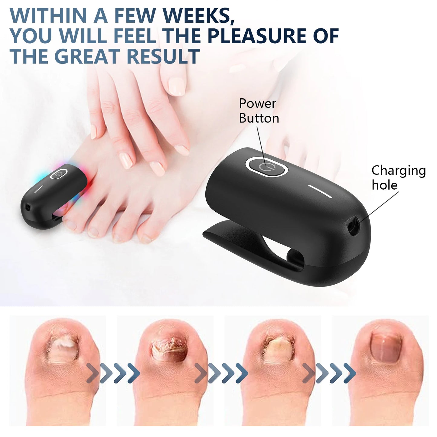 KTS Nail Fungus Laser Device Toenail Laser Therapy Machine - Supersell 