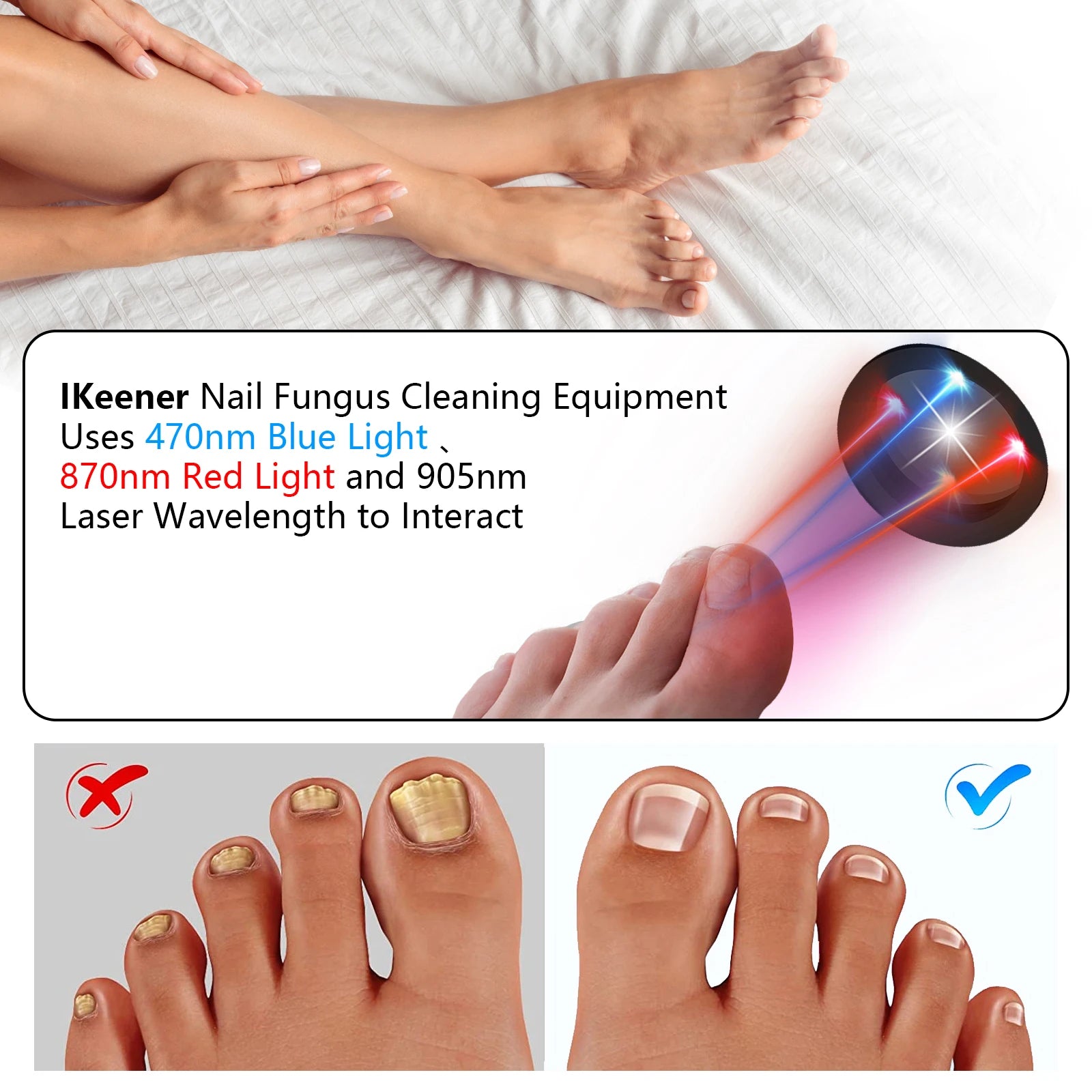 KTS Nail Fungus Laser Device Toenail Laser Therapy Machine - Supersell 